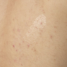 Close-up texture shot of The Ordinary Salicylic Acid 0.5% Body Serum. The clear, lightweight gel is shown applied directly to skin with some visible body acne, demonstrating its consistency.